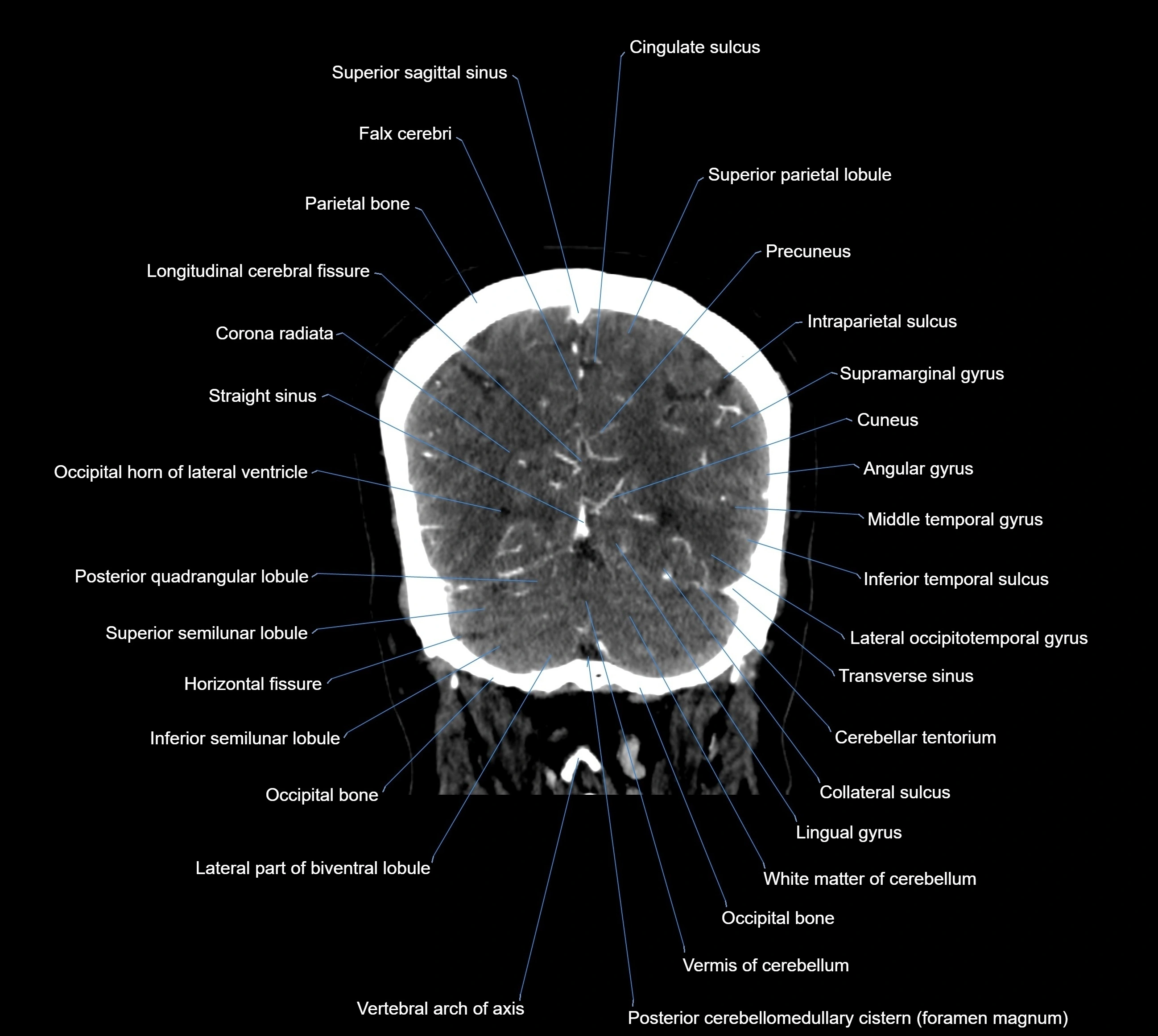 CT Brain coronal cross sectional radiology anatomy image  -img-00001-037.webp